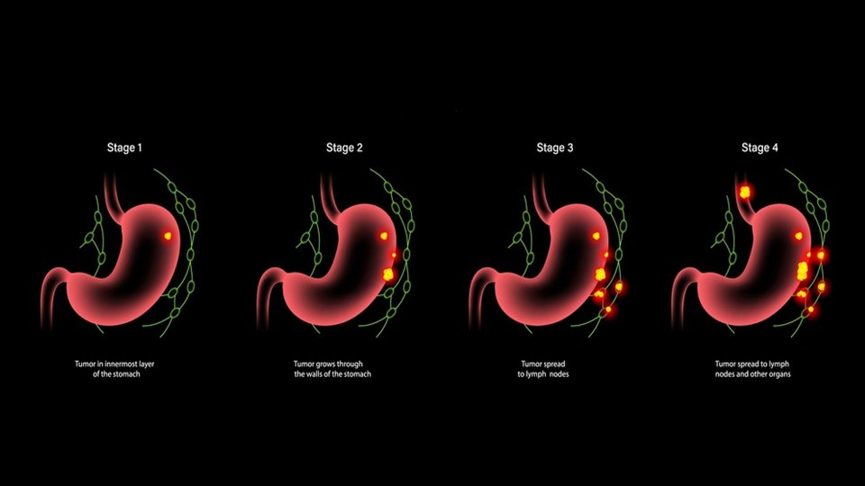 Llojet e kancerit të stomakut dhe trajtimi i tyre 
